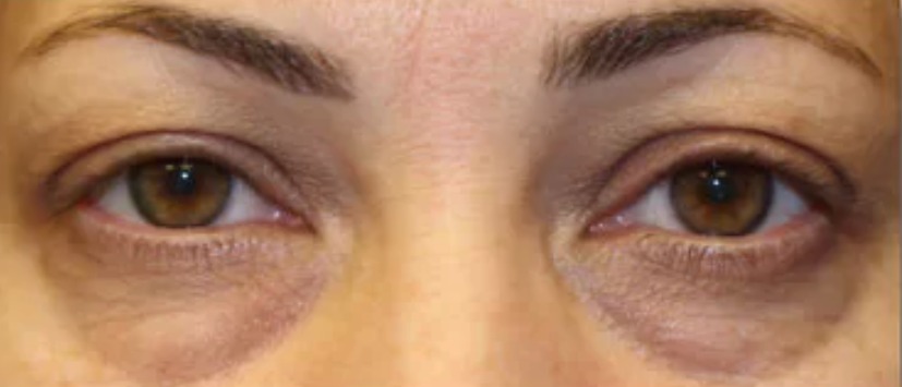 Before Eyes - Front View